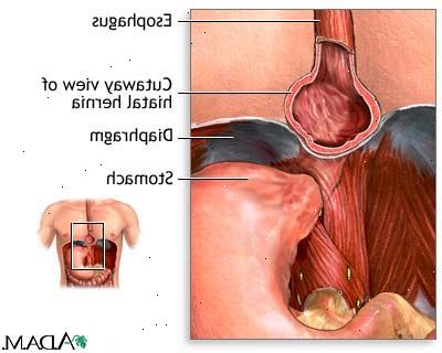 Forberedelser til din avtale. Mulige årsaker til hiatal brokk. Forberedelser til din avtale. Mulige årsaker til hiatal brokk.