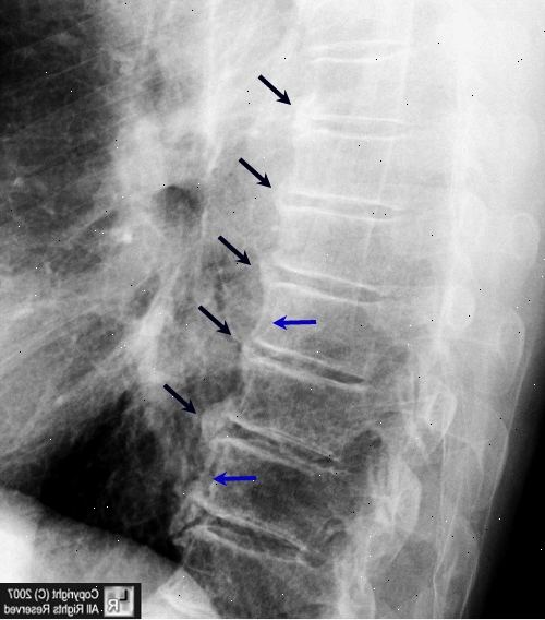 Diffuse idiopatisk skjeletthyperostose (oppvask). Tap av bevegelsesutslag. Diffuse idiopatisk skjeletthyperostose (oppvask). Tap av bevegelsesutslag.