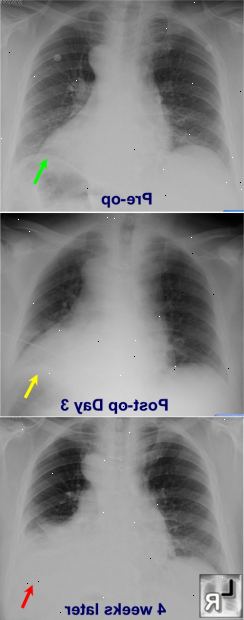 Dressler syndrom. Constrictive perikarditt. Dressler syndrom. Constrictive perikarditt.