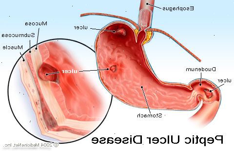Magesår. Smerte er det vanligste symptom. Magesår. Smerte er det vanligste symptom.