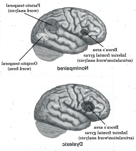 Dysleksi. Skriv ned eventuelle symptomer som barnet opplever. Dysleksi. Skriv ned eventuelle symptomer som barnet opplever.