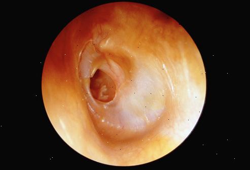 Sprukket trommehinne (perforert trommehinne). Mellomøret infeksjon (otitis media). Sprukket trommehinne (perforert trommehinne). Mellomøret infeksjon (otitis media).