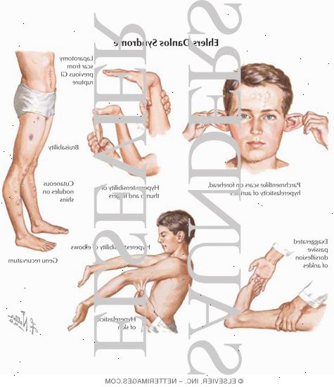 Ehlers-Danlos syndrom. Altfor fleksible ledd. Ehlers-Danlos syndrom. Altfor fleksible ledd.