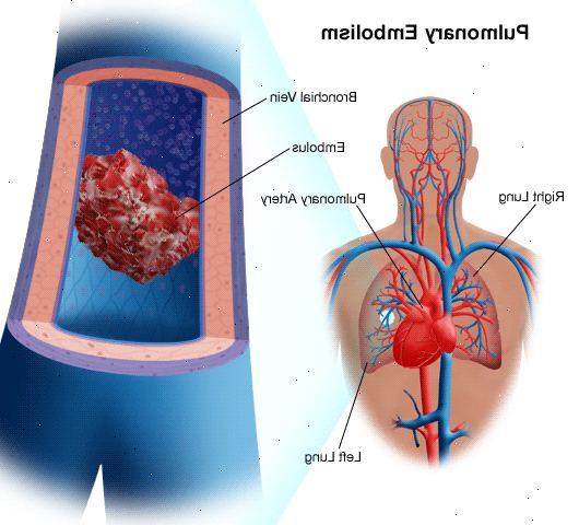Lungeemboli. Tidligere blodpropp. Lungeemboli. Tidligere blodpropp.