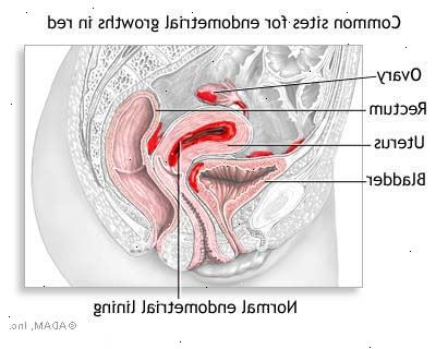 Endometriose. Smertefulle perioder (dysmenoré). Endometriose. Smertefulle perioder (dysmenoré).