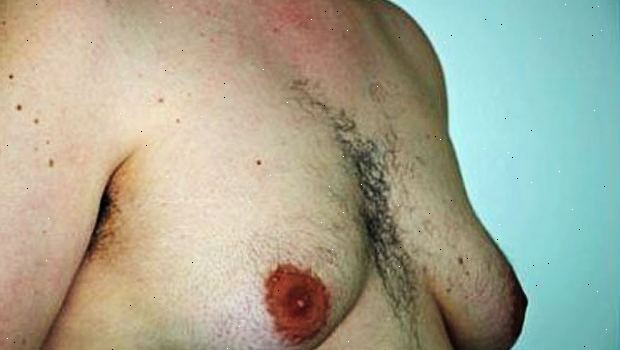Gynecomastia i puberteten. Underernæring og sult. Gynecomastia i puberteten. Underernæring og sult.