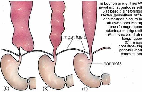 Esophageal spasmer. Typer av esophageal spasmer. Esophageal spasmer. Typer av esophageal spasmer.